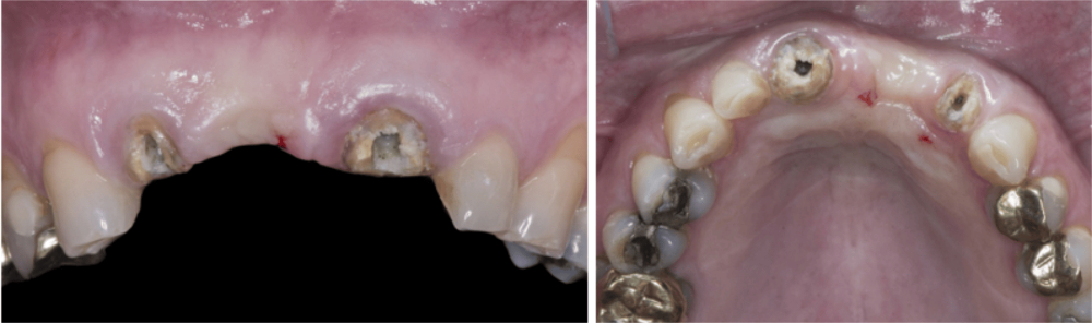 Ritter RI Quadro Spiral Implants